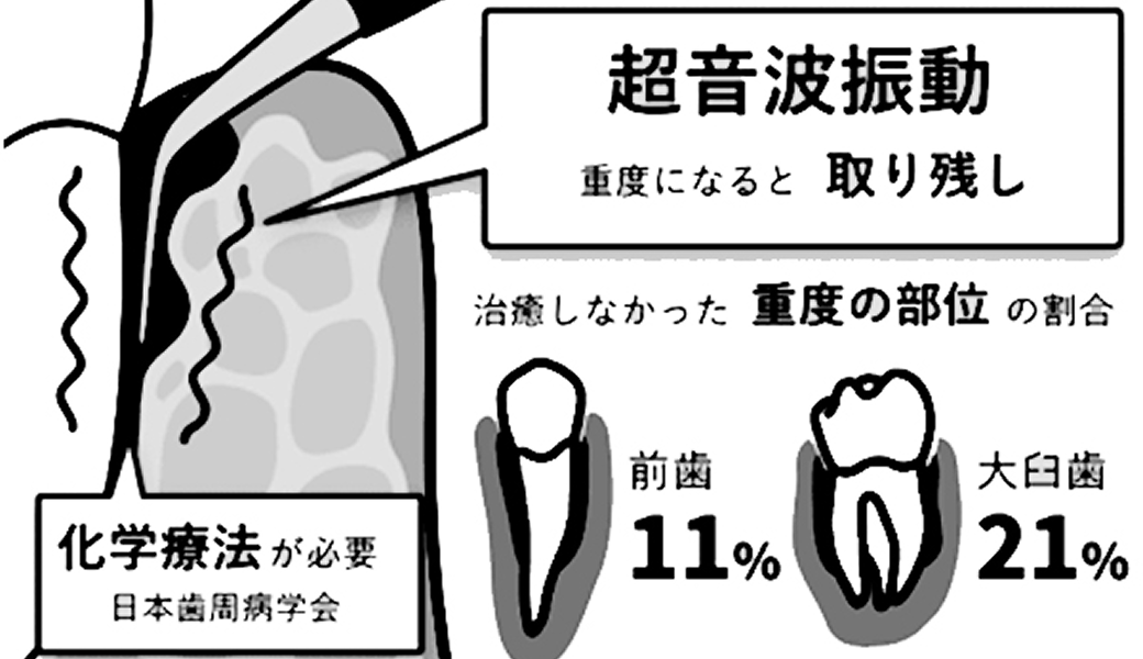 ブルーラジカル