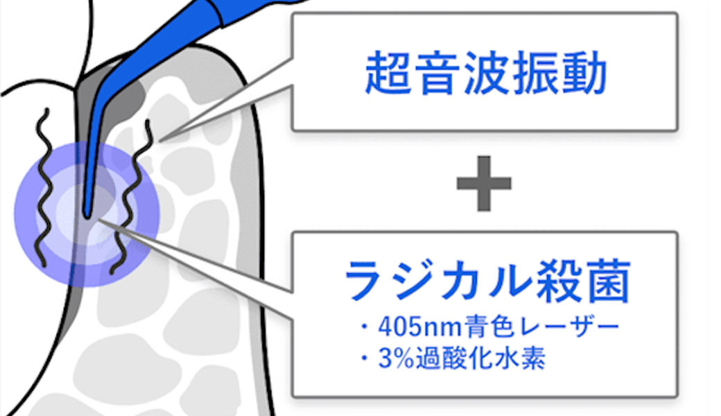 ブルーラジカル